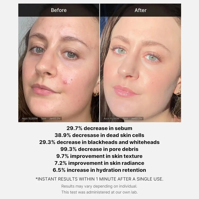 MEDICUBE Red Acne Succinic Acid Peel Serum - DOKAN