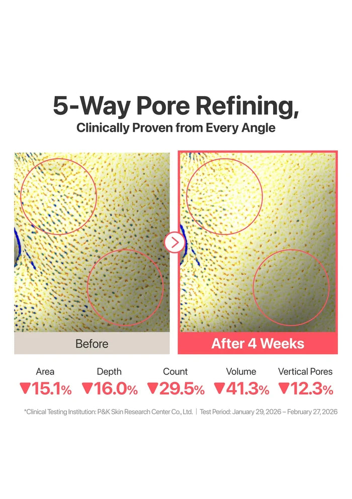 Before and after comparison of 5-way pore refining treatment with clinical data on a white background.